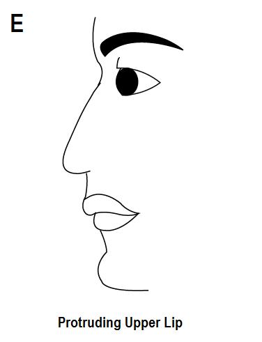 protruding upper lip